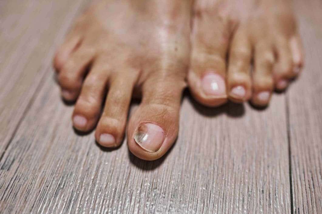 বর্ষাকালে বারবার পায়ের নখ ভেঙে যাচ্ছে?